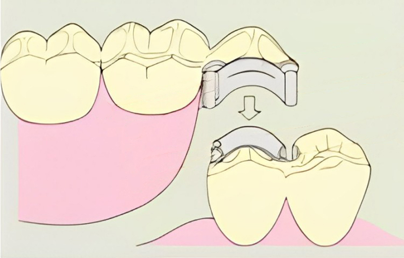 入れ歯・義歯治療イメージ