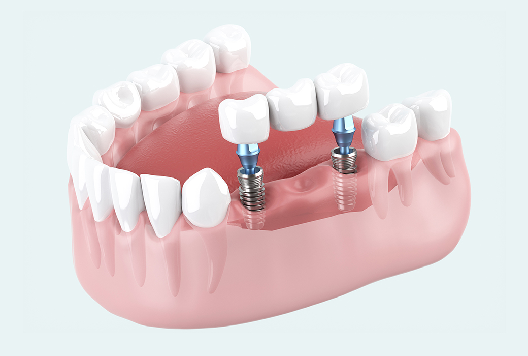 インプラントイメージ