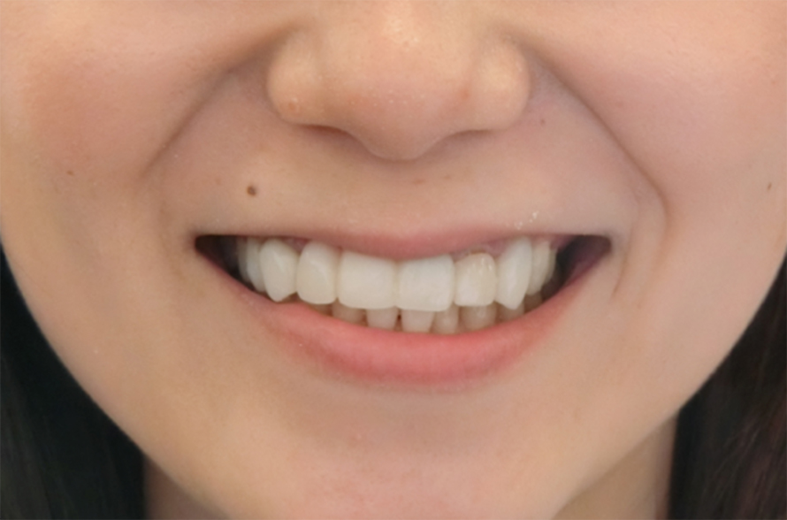 インプラントイメージ